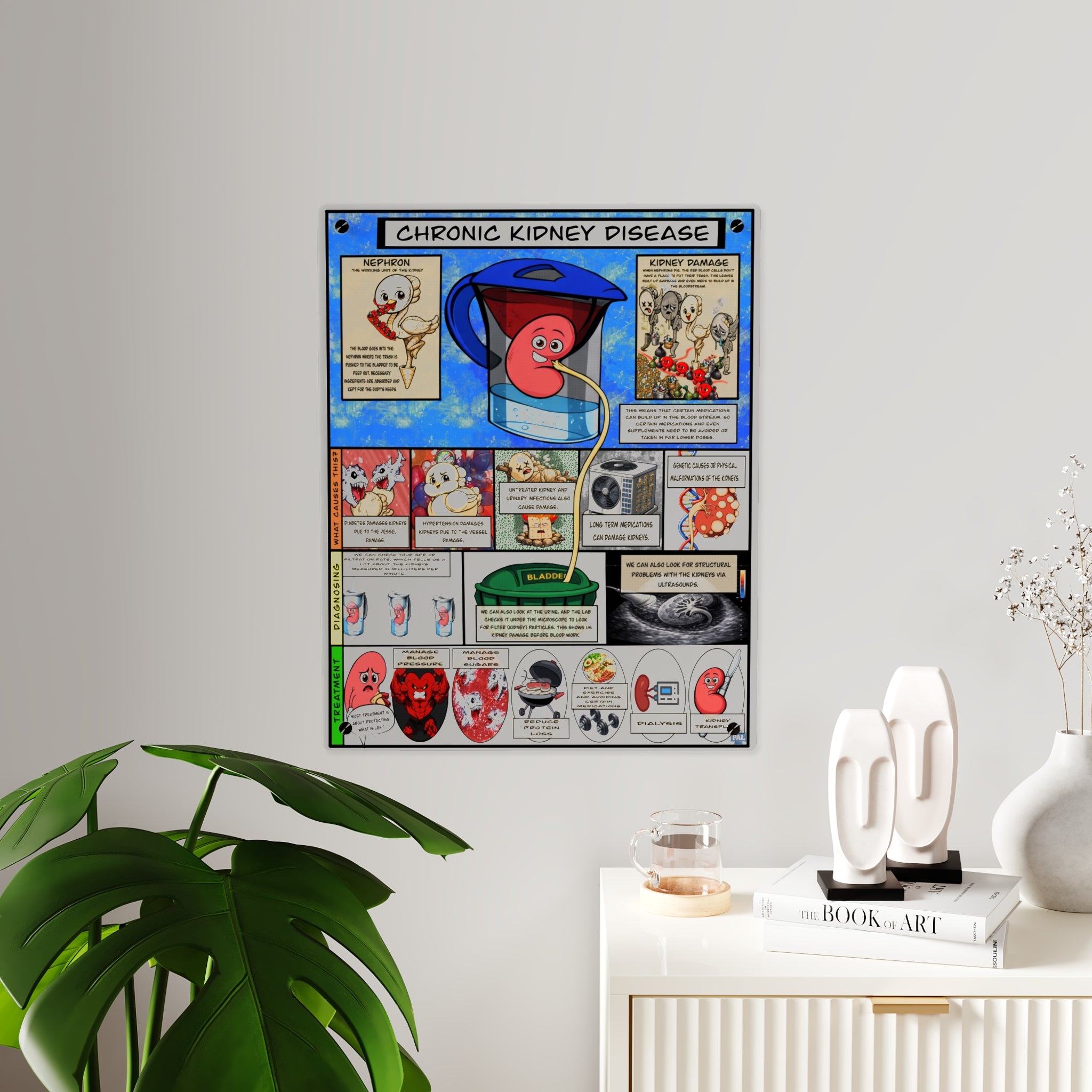 Chronic Kidney Disease Acrylic Wall Art Panel for Patient Education in Clinics and Hospitals